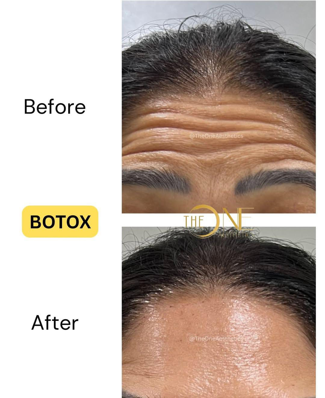 Botox Results